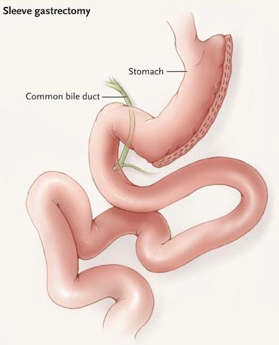 Image of Vertical Sleeve Gastrectomy (VSG) - bariatric surgery